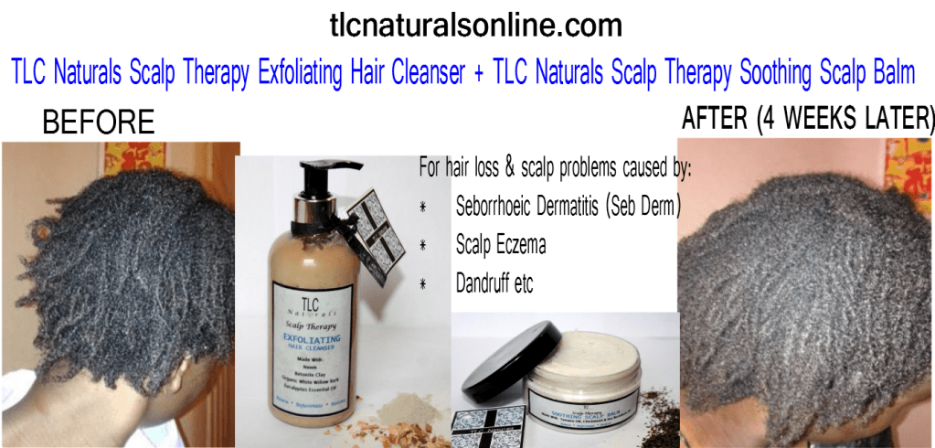 tlc naturals, tlc naturals reviews, tlc naturals hair product review, tlc naturals scalp therapy reviews, scalp therapy, scalp therapy reviews, hair products, seborrhoeic dermatitis, scalp dermatitis, scalp eczema, hair loss, grow hair, hair growth, products for , dry itchy scalp, scalp, eczema, dandruff, sieta, 