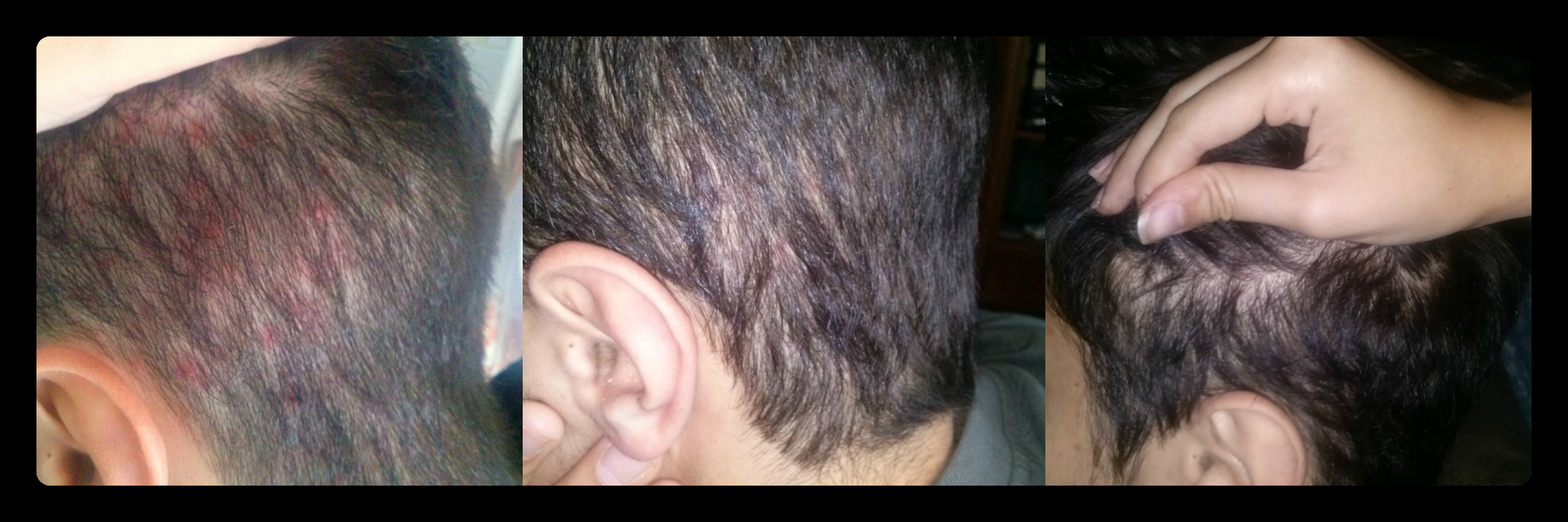 tlc naturals, tlc naturals reviews, tlc naturals hair product review, tlc naturals scalp therapy reviews, scalp therapy, scalp therapy reviews, hair products, seborrhoeic dermatitis, scalp dermatitis, scalp eczema, hair loss, grow hair, hair growth, products for , dry itchy scalp, scalp, eczema, dandruff, sieta, tlc naturals, review, feedback, scalp therapy, scalp therapy hair cleanser, scalp therapy soothing balm, tlc naturals reviews, tlc naturals feedback, seb derm, dermatitis, scalp eczema, shampoo, hair cleanser, cream, balm, salve, dermatite seborroica, prodotti, prodotti naturali, problematiche del cuoio capelluto, capelli, dermatite, prurito,, italia,